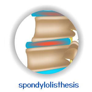 picture of Fort Wayne spondylolisthesis